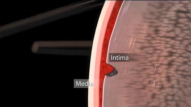 Hypoplastic left heart syndrome is a rare congenital heart defect in which the left side of the heart is severely underdeveloped.It may affect the left ventricle, aorta, aortic valve, or mitral valve. 3D Render