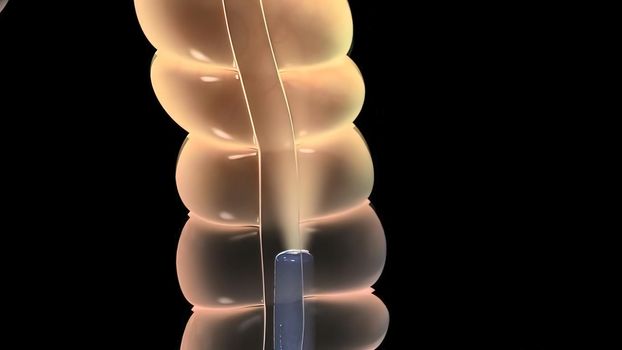 Colonoscopy Biopsy Of The Gastrointestinal Tract In Patients 3D illustration