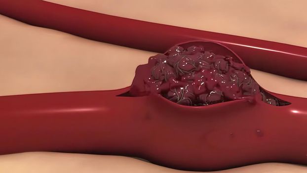 A brain aneurysm is a bulge or ballooning in a blood vessel in the brain. It often looks like a berry hanging on a stem. 3D illustration