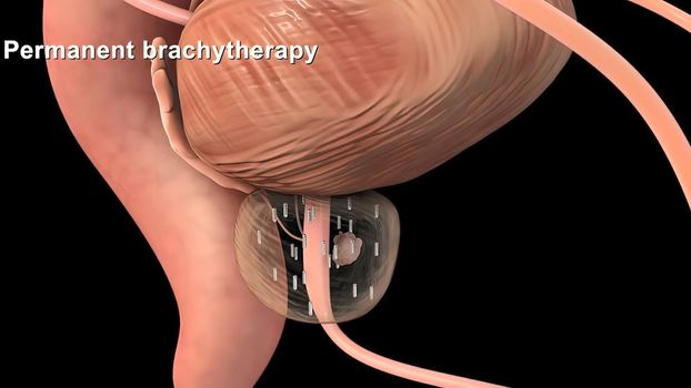 Medically accurate 3d illustration of prostate cancer 3D illustration