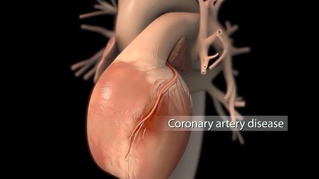 Carotid Artery Disease 3D Medical illustration .