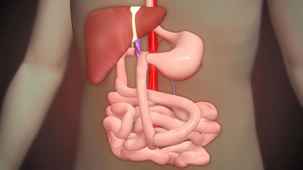A bowel resection is a surgery to remove any part of the bowel. This includes the small intestine, large intestine, or rectum. 3D illustration