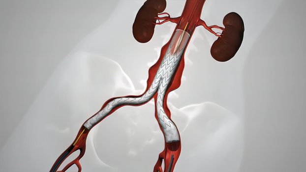 balloon angioplasty procedure with stent in vein 3D illustration