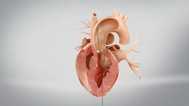 Coronary reimplantation in ascending aortic aneurysm 3D Render