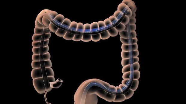 During a colonoscopy, a long, fleible tube (colonoscope) is inserted into the rectum. 3D illustration