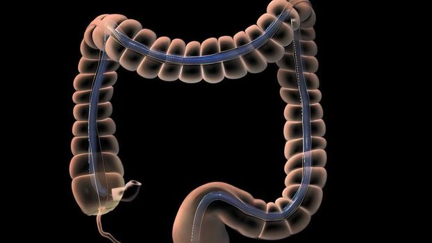 Colonoscopy Biopsy Of The Gastrointestinal Tract In Patients 3D illustration