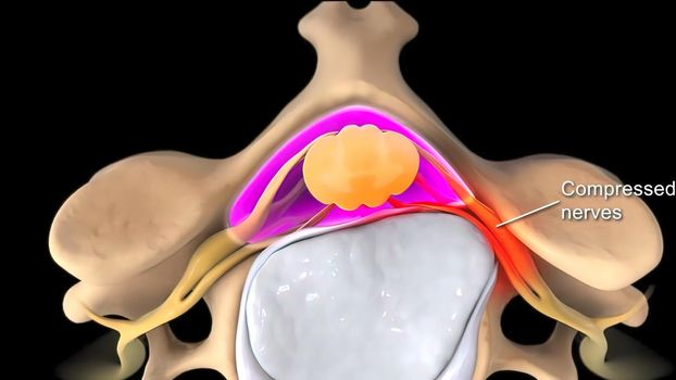 Pressure applied to the nerve as a result of the fracture of the spinal disc 3D illustration