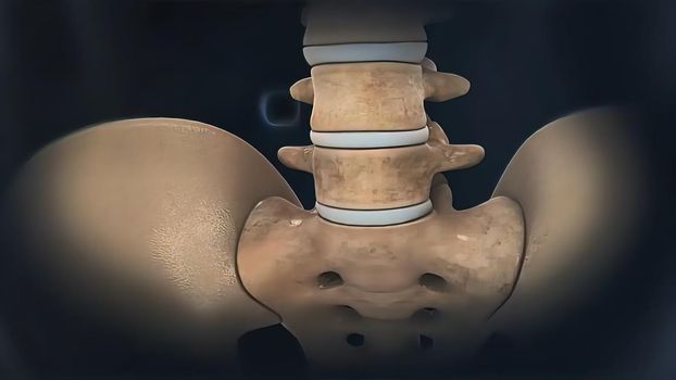 3D illustration of the effects of arthritis on a healthy lumbar spine. The effects of arthritis include the collapse and compression of the intervertebral discs (grey),