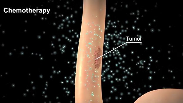 Cancer cell death, tumor death, destruction of normal cells and tissue. It also covers the side effects associated with chemotherapy treatments. 3D illustration