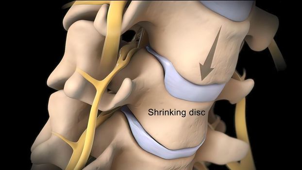 Pressure applied to the nerve as a result of the fracture of the spinal disc 3D illustration