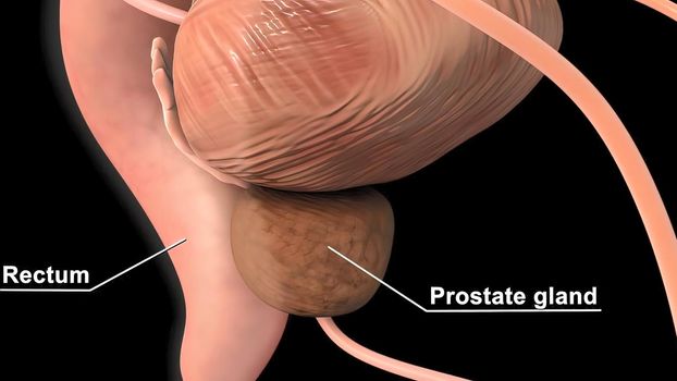 Medically accurate 3d illustration of prostate cancer