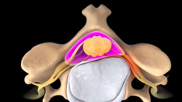 Breaking of the deformed disc and putting pressure on the nerve 3D illustration