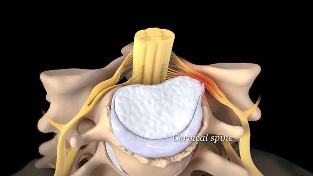 Spinal disc herniation is an injury to the cushioning and connective tissue between vertebrae, usually caused by excessive strain or trauma to the spine. 3D Render