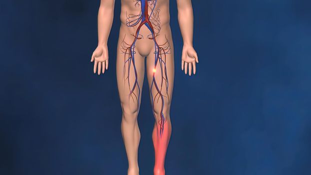 Blood clots are semi-solid masses of blood that can be stationary (thrombosis) and block blood flow or break loose (embolism) 3D Illustration