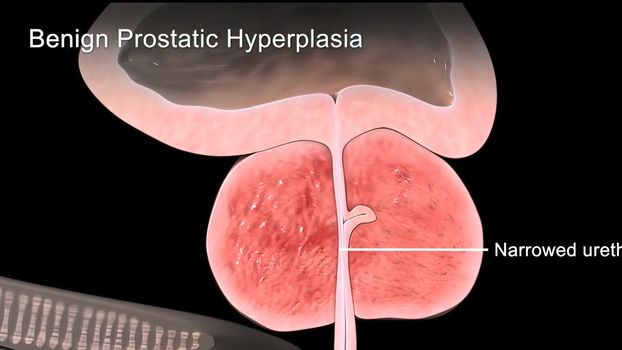 Benign Prostatic Hyperplasia 3d medical .