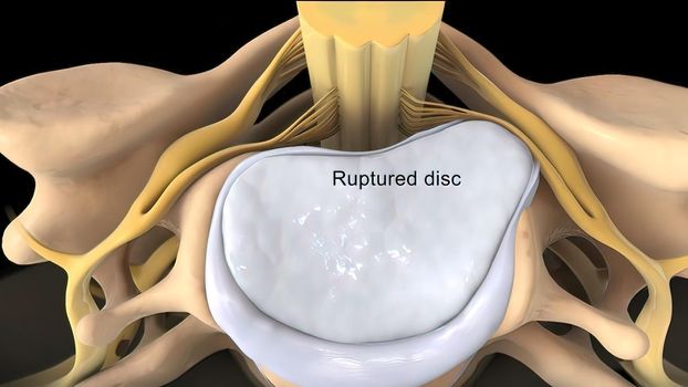 Central disc protrusion top view 3D illustration
