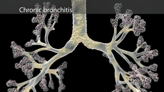 The characteristic cough of bronchitis is caused by the copious secretion of mucus in chronic bronchitis. 3D illustration