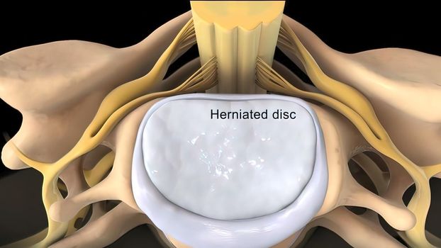 Central disc protrusion top view 3D illustration