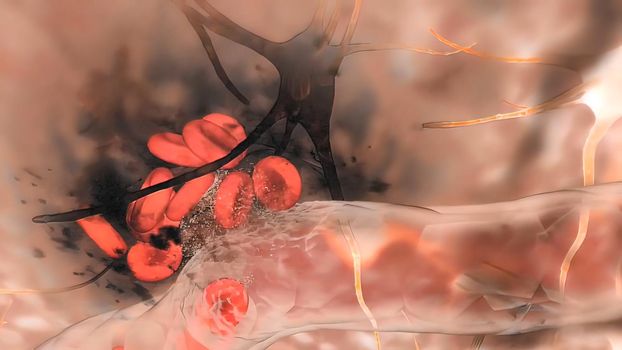 A brain aneurysm can leak or rupture, causing bleeding into the brain (hemorrhagic stroke). 3D illustration