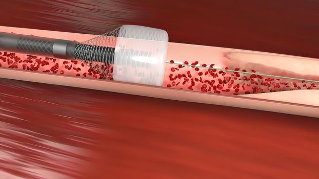 Vascular occlusion is a blockage of a blood vessel, usually with a clot. 3D illustration