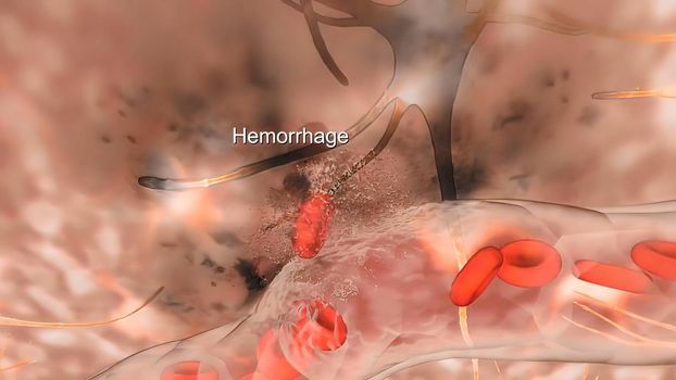 A brain aneurysm can leak or rupture, causing bleeding into the brain (hemorrhagic stroke). 3D illustration