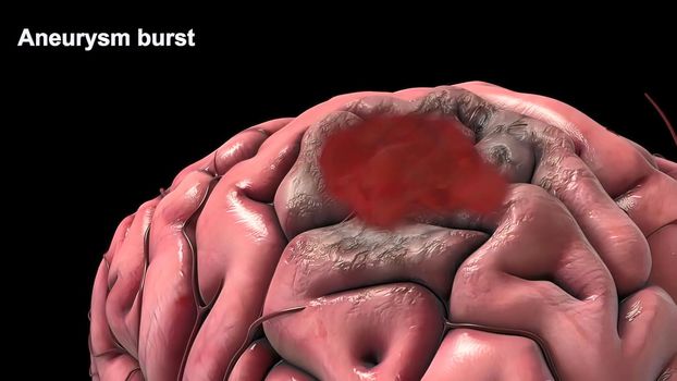 A brain aneurysm can leak or rupture, causing bleeding into the brain (hemorrhagic stroke). 3D illustration