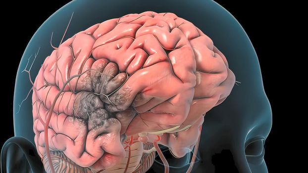 A brain aneurysm can leak or rupture, causing bleeding into the brain (hemorrhagic stroke). 3D illustration