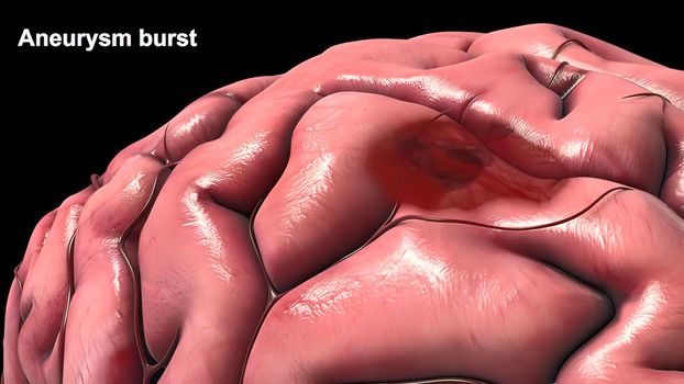 A brain aneurysm can leak or rupture, causing bleeding into the brain (hemorrhagic stroke). 3D illustration