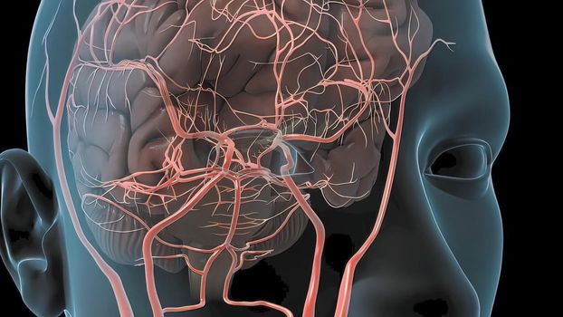 A brain aneurysm can leak or rupture, causing bleeding into the brain (hemorrhagic stroke). 3D illustration