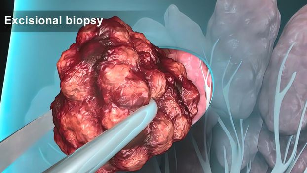 Breast cancer Girl with breast pathology. . Illustration and close-up of female human structure. 3D illustration