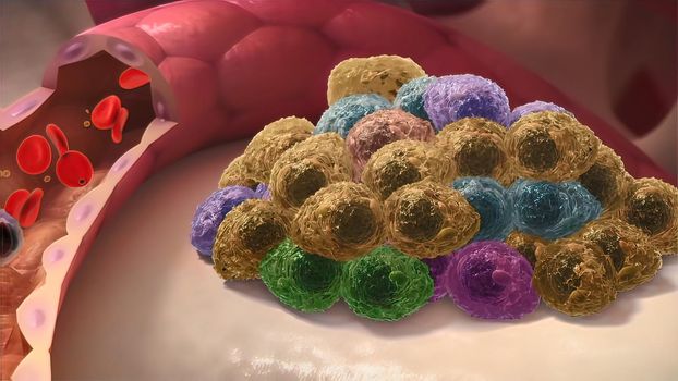 Multiple Myeloma, a type of cancer that consists of white blood cells and its spread. 3D illustration