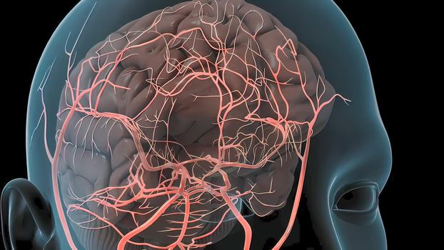 A brain aneurysm can leak or rupture, causing bleeding into the brain (hemorrhagic stroke). 3D illustration