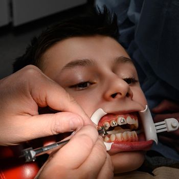 The orthodontist installs braces for the student's boyfriend, visits to the dentist, installation of braces on the upper teeth, retractor on the patient's lips.