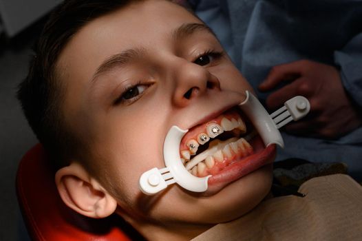 Close up of installing braces on teeth, aligning teeth with braces, retractor on lips, visit to dentist.