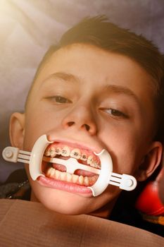 Visit to the orthodontist, installation of braces on the upper teeth, white retractor on the lips of the child, alignment of the teeth.