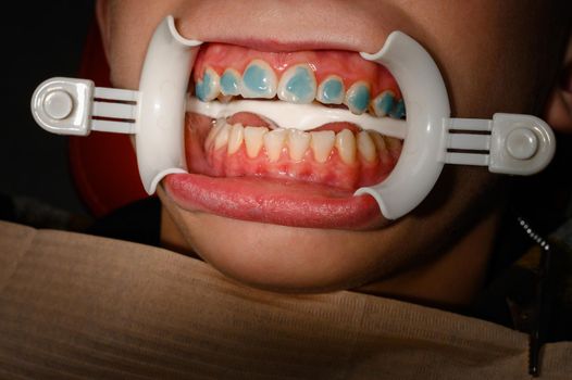 Plastic retractor for lip augmentation in the mouth, dental procedure and retractor as an auxiliary element, applied gel on the teeth.