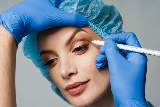 Blepharoplasty markup close-up on the face before the plastic surgery operation for modifying the eye region of the face in medical clinic.