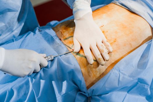 Close-up liposuction of abdomen. Surgeon does abdominoplasty for woman. Plastical operation in medical clinic.