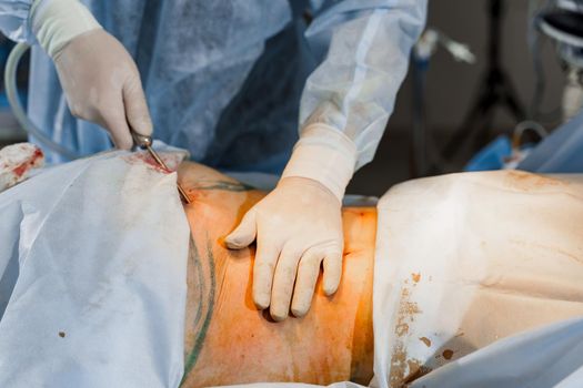 Surgeon removes fat in the gluteal region close-up. Abdominoplasty - plastic operation to reduce the abdomen and remove cellulite.