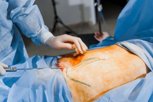 Close-up liposuction of abdomen. Surgeon does abdominoplasty for woman. Plastical operation in medical clinic.