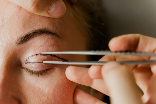 Blepharoplasty markup close-up on the face before the plastic surgery operation for modifying the eye region of the face in medical clinic. 2 doctors do plastic cosmetic operation