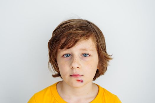 Portrait of school boy kid child with sore bruised wound on his face. Caucasian schoolboy in yellow t-shirt hurt his face on white background with copy space for text.