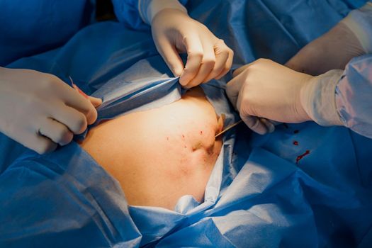 Liposuction for lipofilling surgery operation. close-up photo of 2 surgeon do plastic surgery named blepharoplasty in medical clinic.