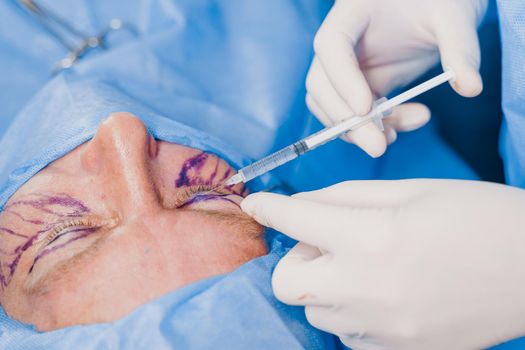 Close-up anesthesia before blepharoplasty and lipofilling plastic surgery operation for modifying the eye region of the face in medical clinic