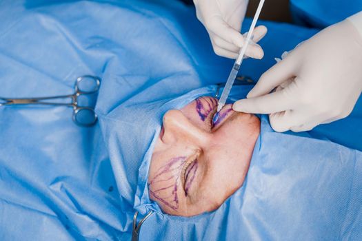 Close-up anesthesia before blepharoplasty and lipofilling plastic surgery operation for modifying the eye region of the face in medical clinic