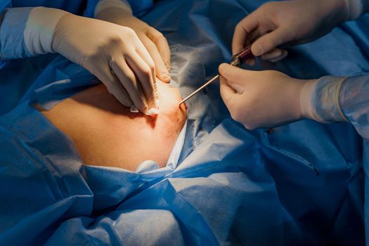 Liposuction for lipofilling surgery operation. close-up photo of 2 surgeon do plastic surgery named blepharoplasty in medical clinic.