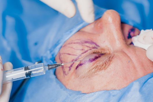 Close-up anesthesia before blepharoplasty and lipofilling plastic surgery operation for modifying the eye region of the face in medical clinic