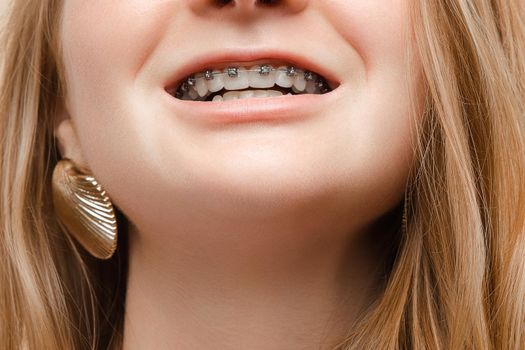 Extreme close-up teenager woman smiling with open mouth showing braces on teeth. Face of European young girl enjoying dental care wearing bracket having positive emotion