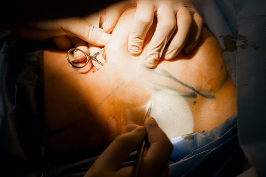 Surgeon surgeon sutures chest of woman after operation. Tits augmentation plastic operation and correction in medical clinic