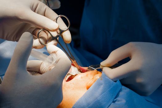 Buccal fat removal. Bisha lumps removal. Plastic surgery in clinic. Plastic surgery operation for modifying face in medical clinic.